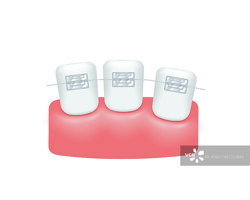 牙齿正畸治疗图片素材