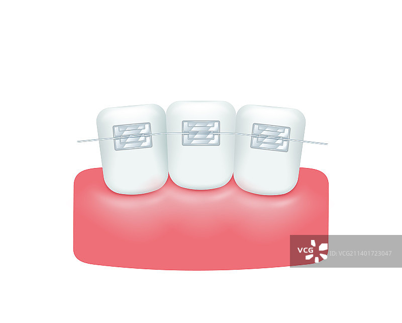正畸牙套后的美丽整齐牙齿图片素材