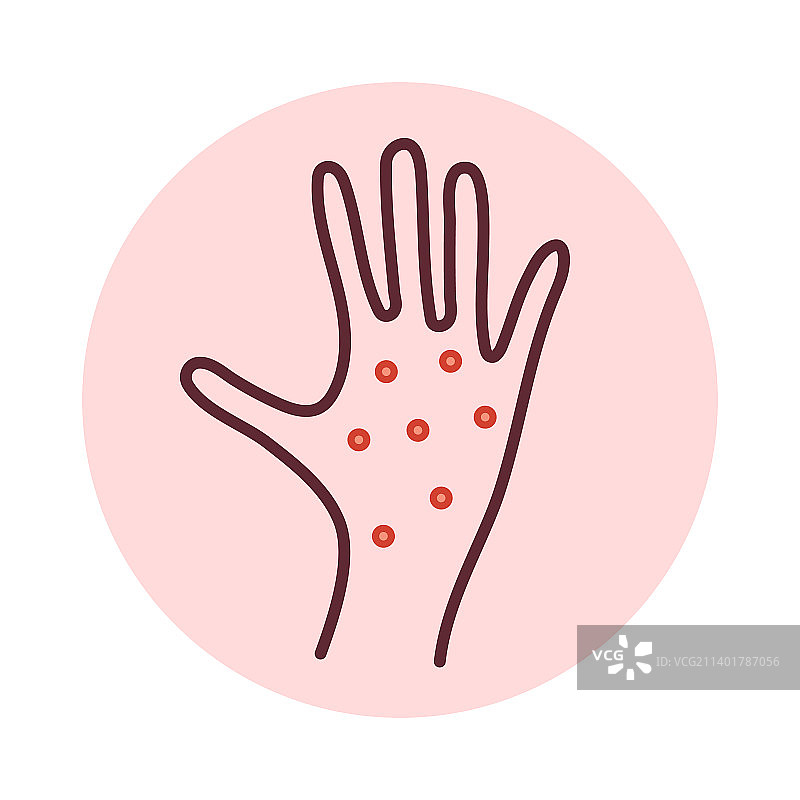 手部皮疹，过敏或猴痘病毒感染图片素材