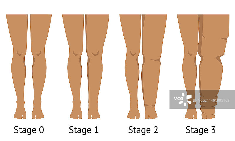 不同淋巴水肿阶段的女人腿图片素材