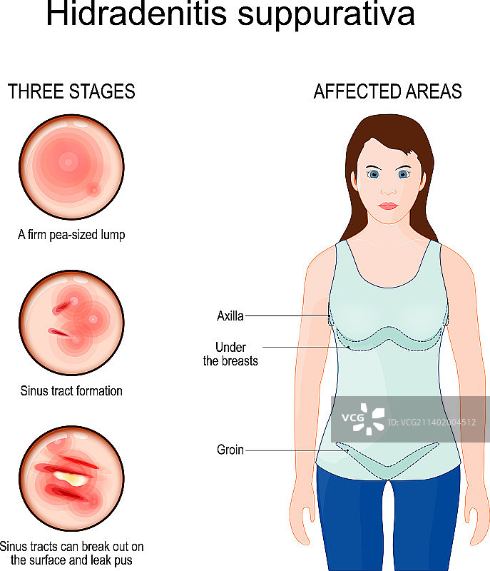 化脓性汗腺炎痤疮患处图片素材
