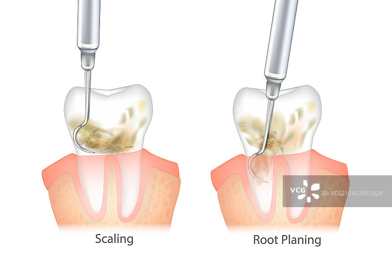 牙周洁治术与根面平整术的区别图片素材