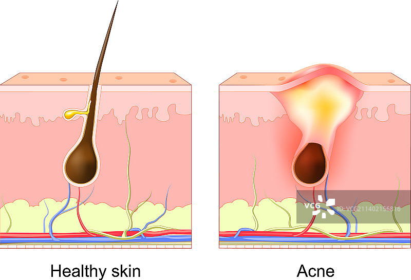 痤疮粉刺正常毛囊和堵塞的毛孔图片素材