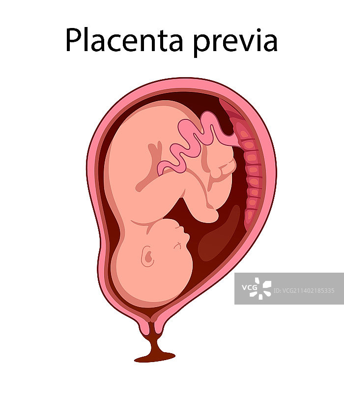 妊娠期间子宫内的前置胎盘胎儿图片素材