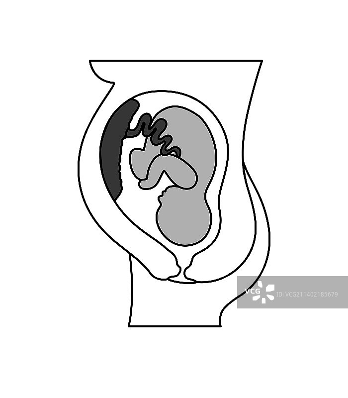 妊娠期间子宫内的前置胎盘胎儿图片素材