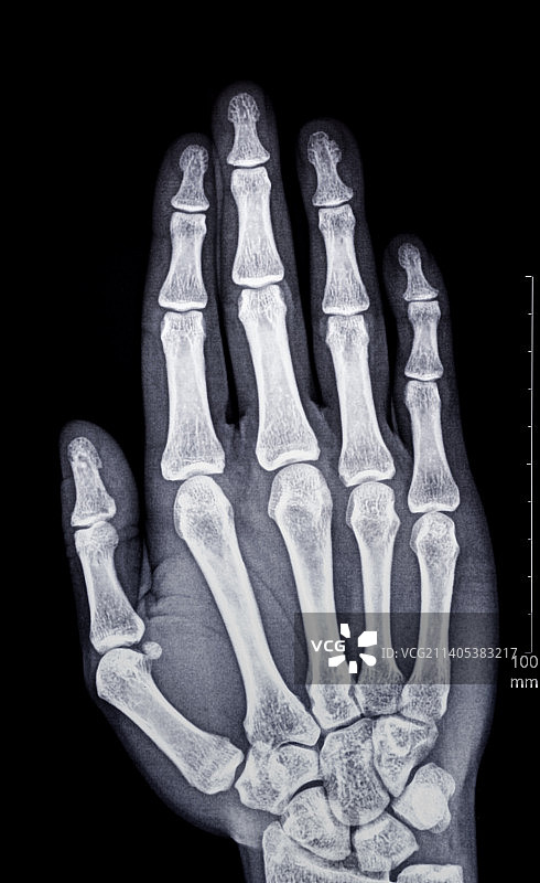 手指骨骼X光照片图片素材