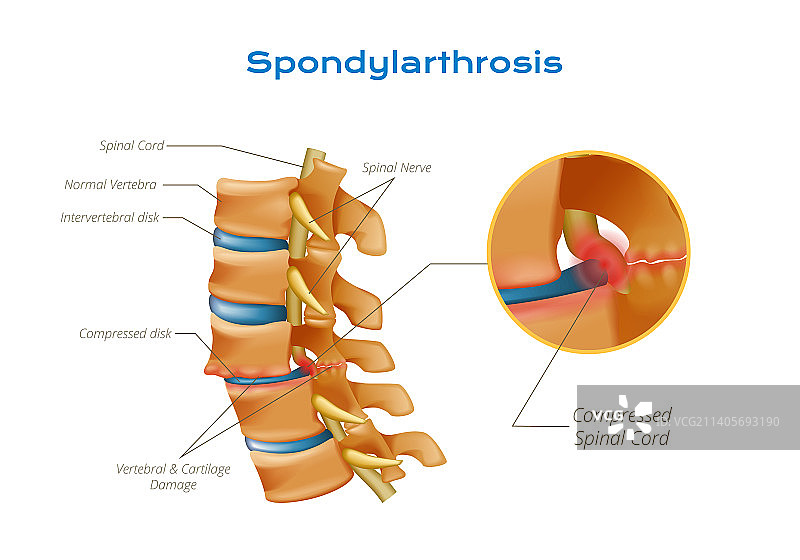 脊椎关节病脊髓信息图图片素材