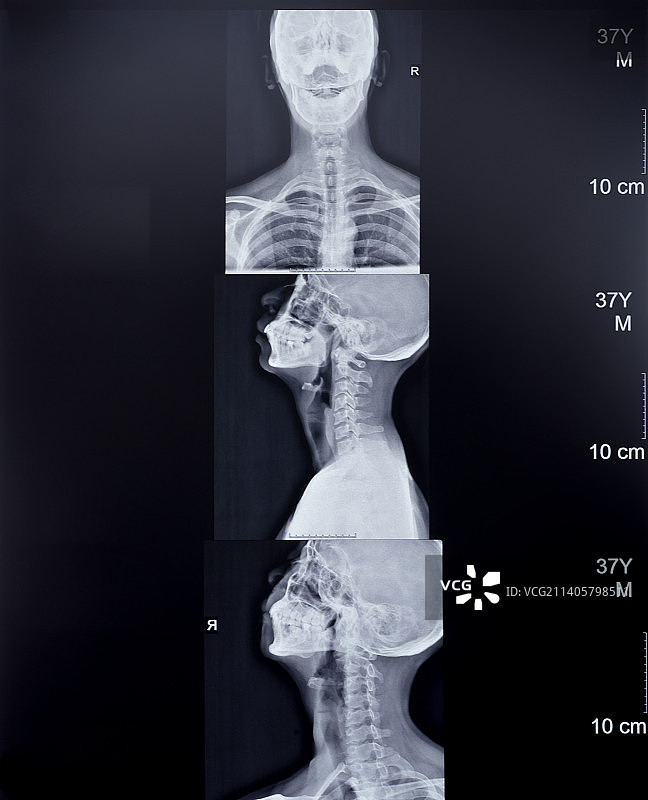 颈椎X光片图片素材