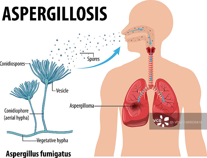 显示曲霉菌感染的图图片素材