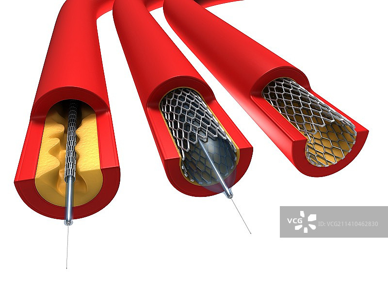 血管成形术（艺术作品）图片素材