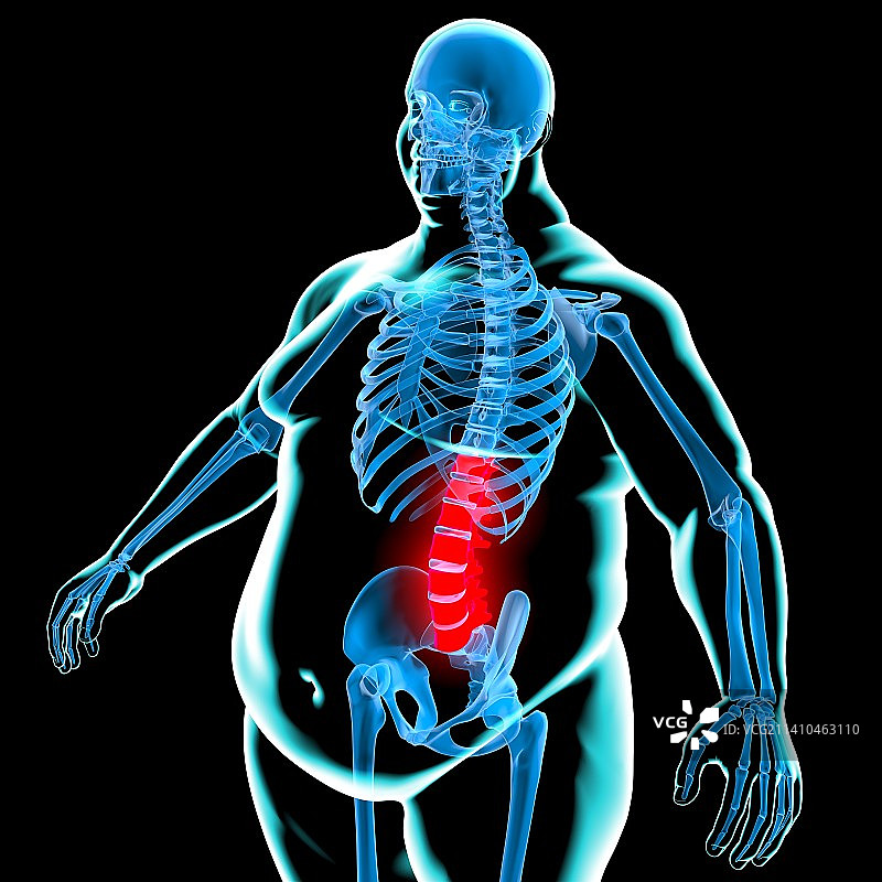 肥胖引起的背痛概念图图片素材