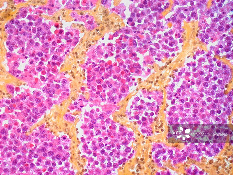 睾丸癌光学显微照片图片素材