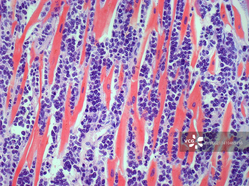 继发性心脏癌，光学显微照片图片素材