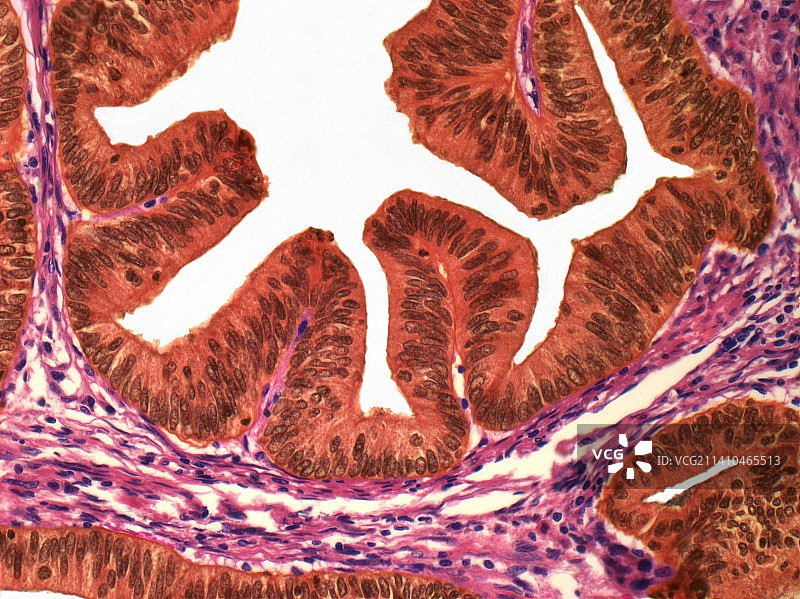 子宫癌，光学显微照片图片素材
