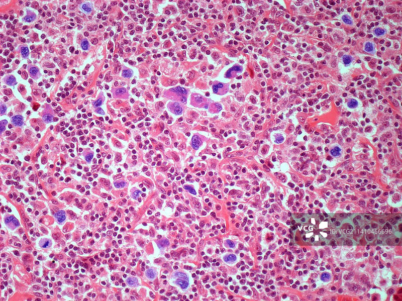 霍奇金淋巴瘤显微照片图片素材