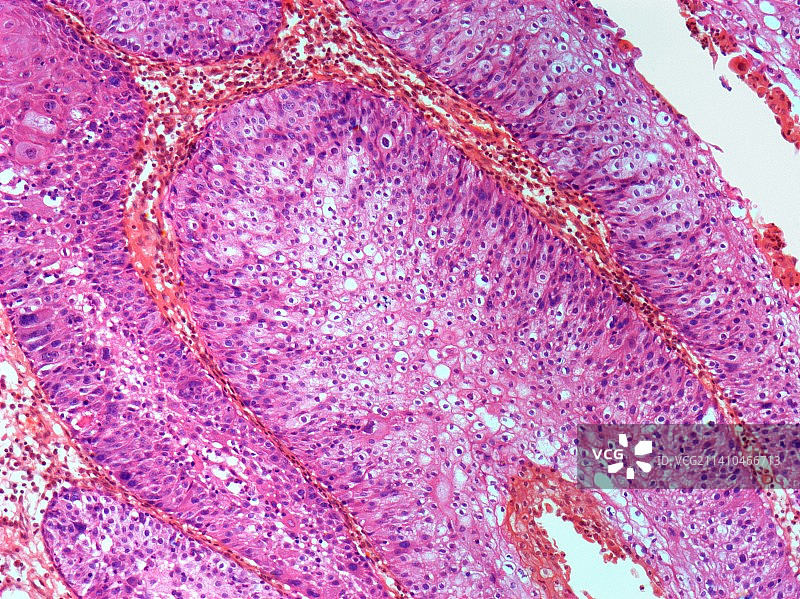 疣，光学显微镜照片图片素材