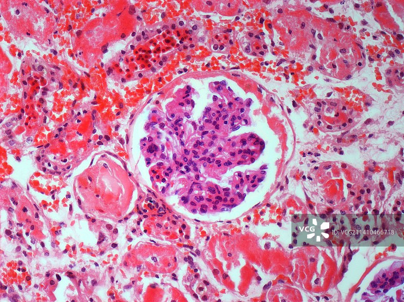 肾脏疾病显微照片图片素材