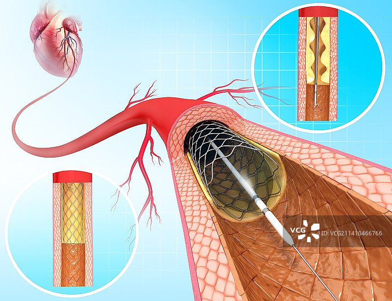 血管成形术（艺术作品）图片素材