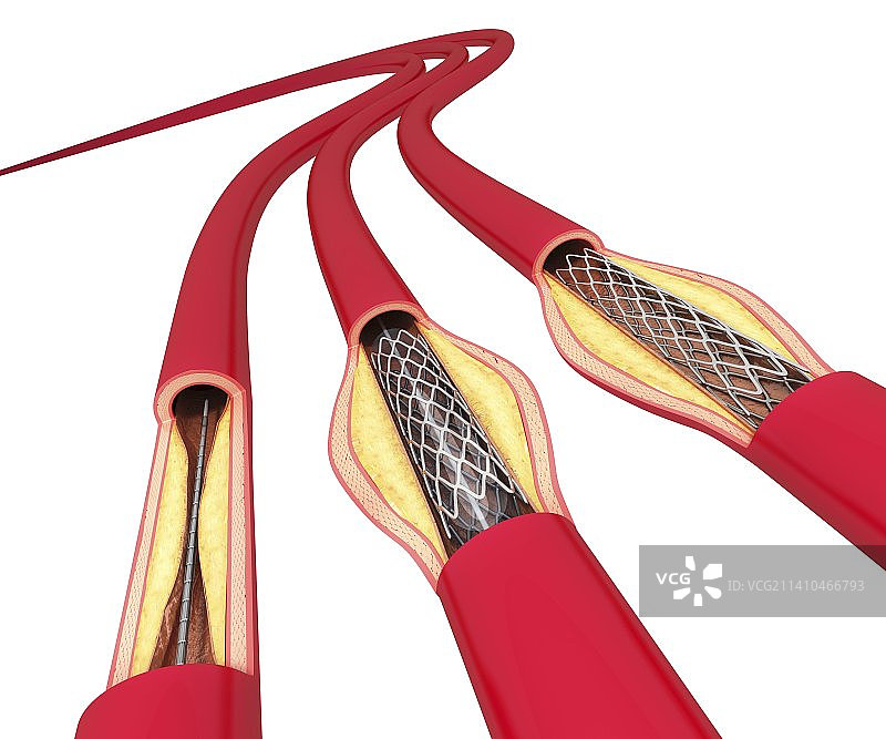 血管成形术（艺术作品）图片素材
