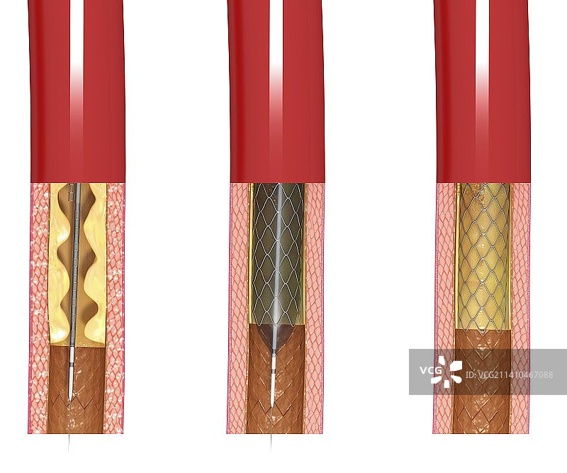 血管成形术（艺术作品）图片素材