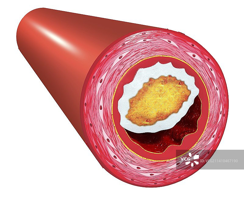 动脉粥样硬化医学插图图片素材