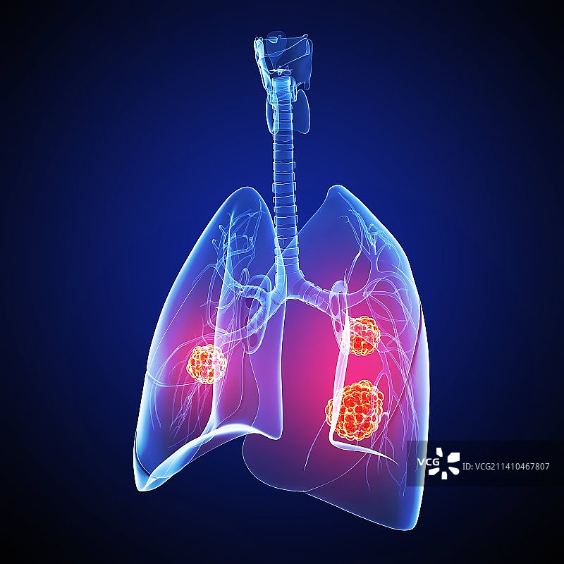 肺癌艺术作品图片素材