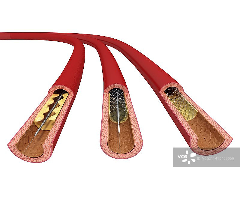 血管成形术（艺术作品）图片素材