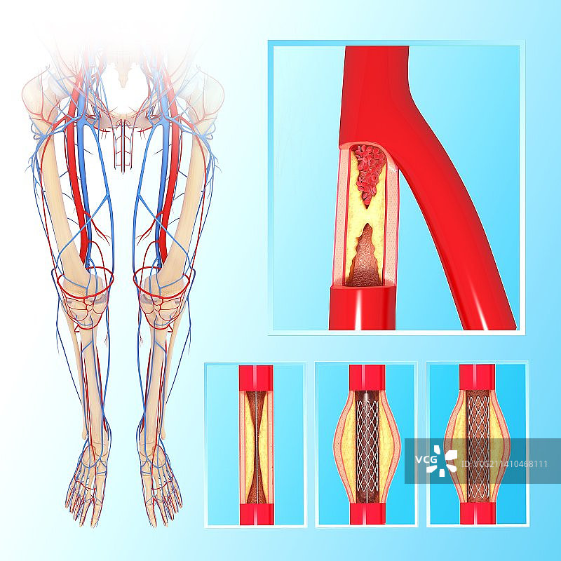 血管成形术（艺术作品）图片素材