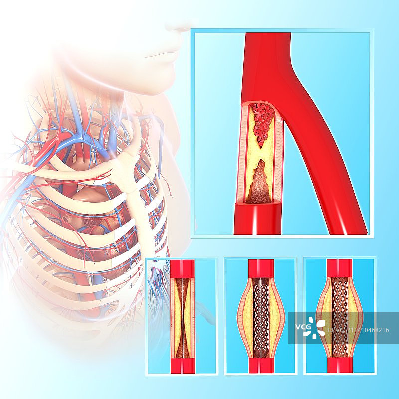 血管成形术（艺术作品）图片素材