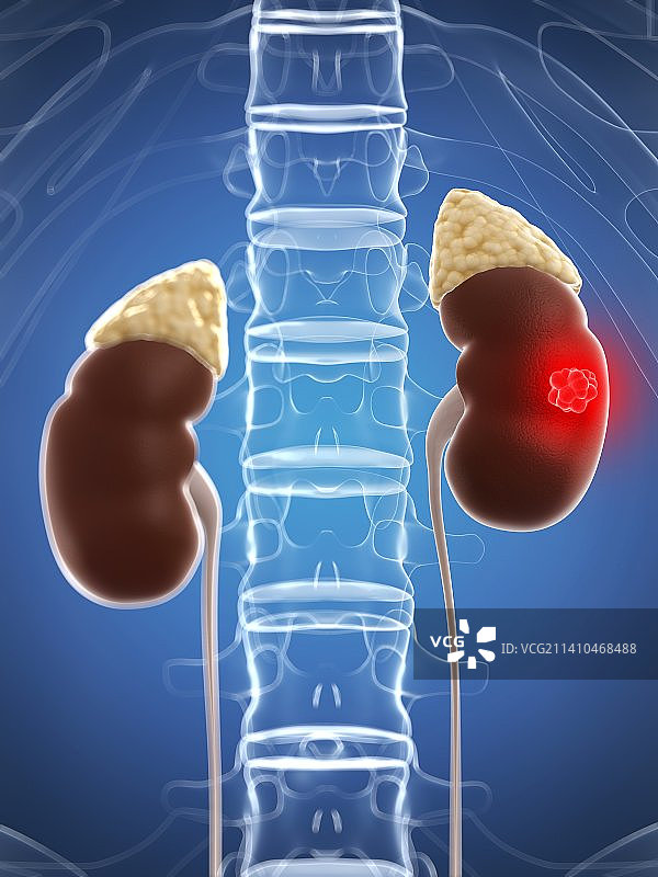 肾癌医学插图图片素材