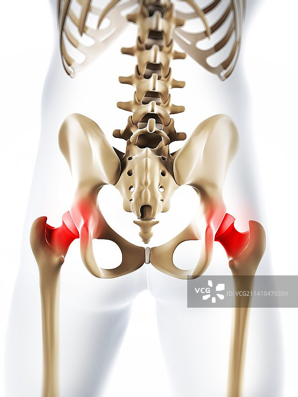 髋关节疼痛概念艺术图图片素材