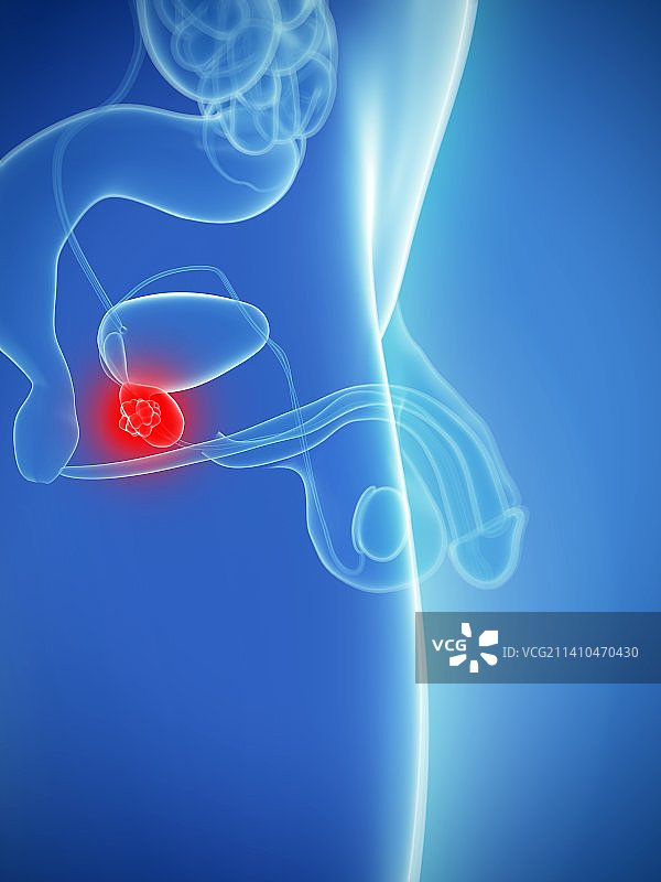 前列腺癌医学插图图片素材