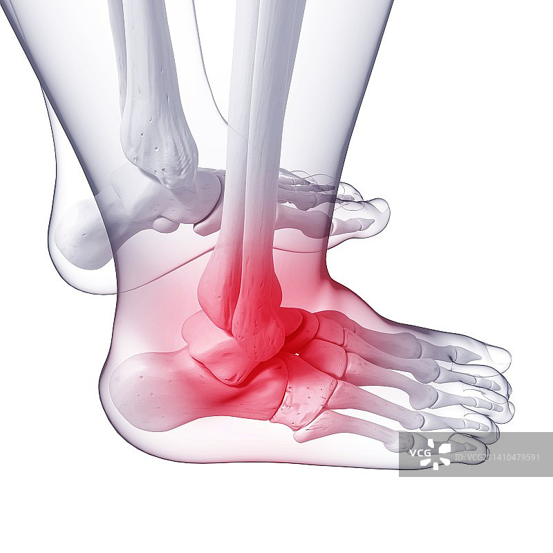 脚痛，艺术作品图片素材