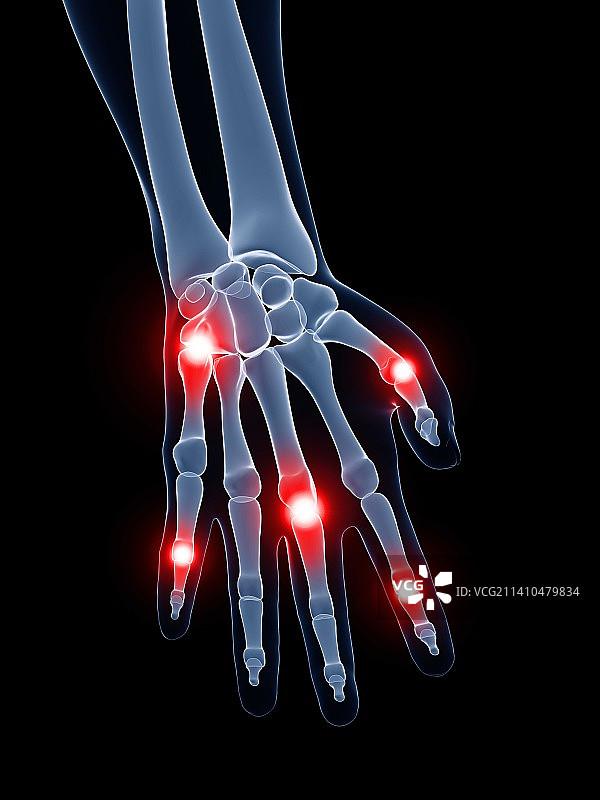 疼痛的手指关节医学插图图片素材