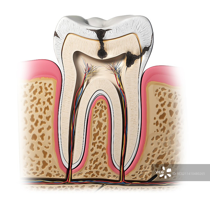 牙齿腐烂，艺术作品图片素材
