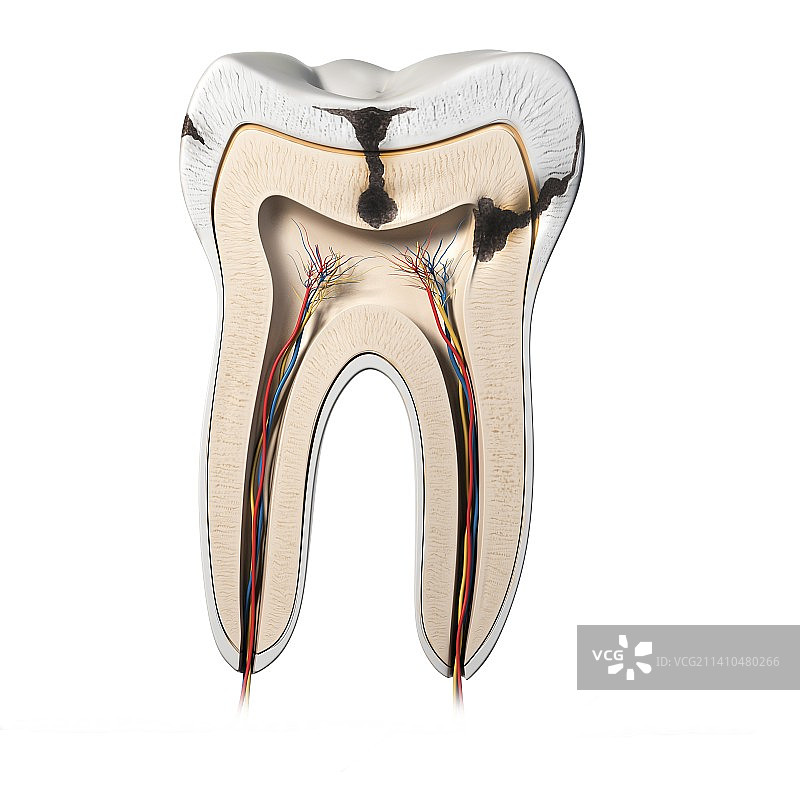 牙齿腐烂，艺术作品图片素材