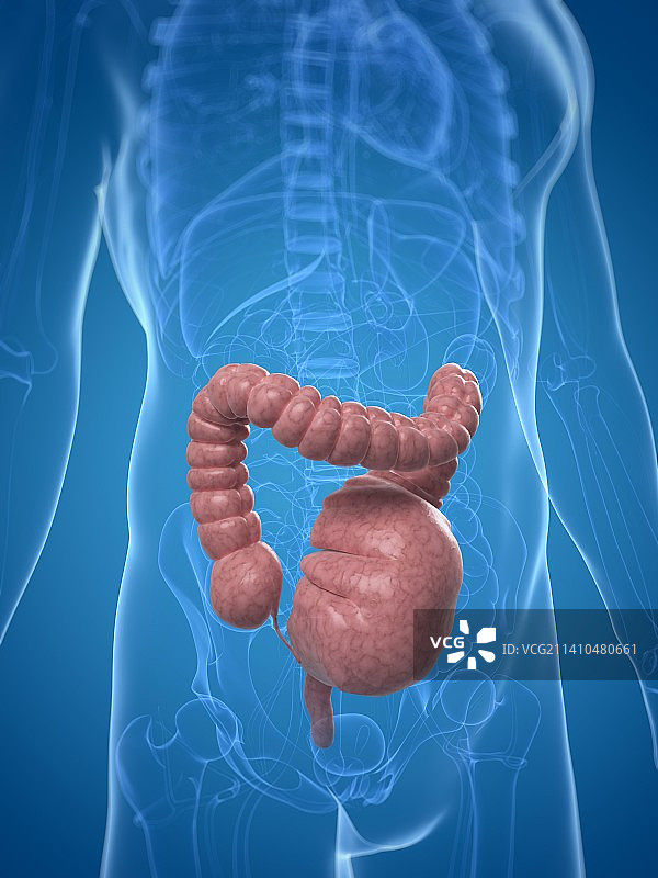 中毒性巨结肠，艺术作品图片素材