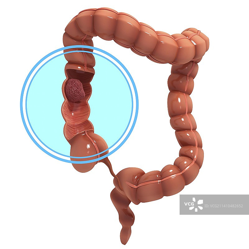 结肠癌，艺术作品图片素材