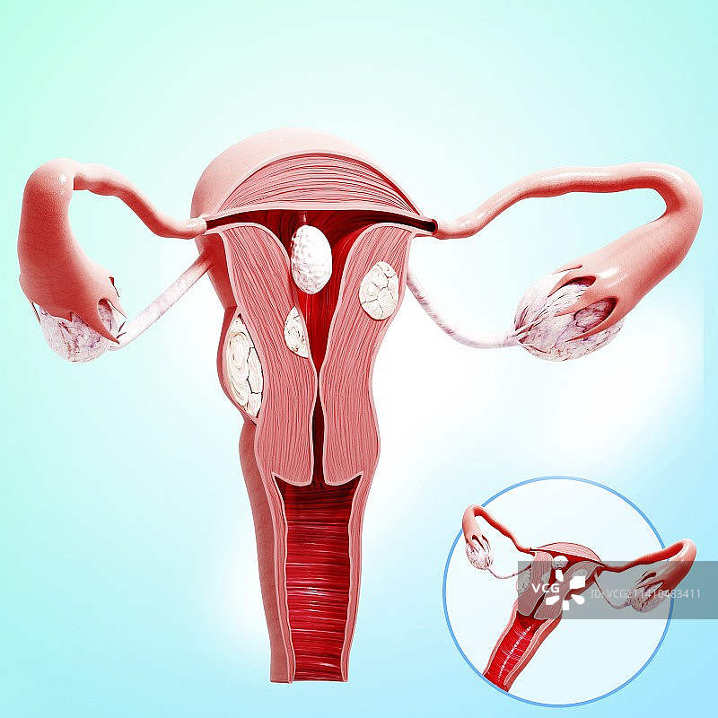 子宫癌，示意图，仅做科普示意。图片素材