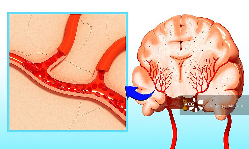 脑硬膜外血肿，示意图，仅做科普示意。图片素材
