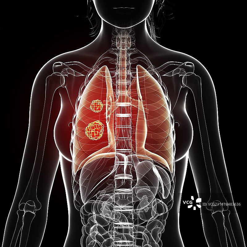 肺癌艺术作品图片素材