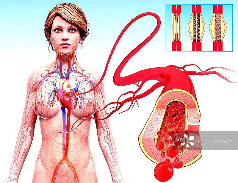 血管成形术、人体解剖学插图图片素材