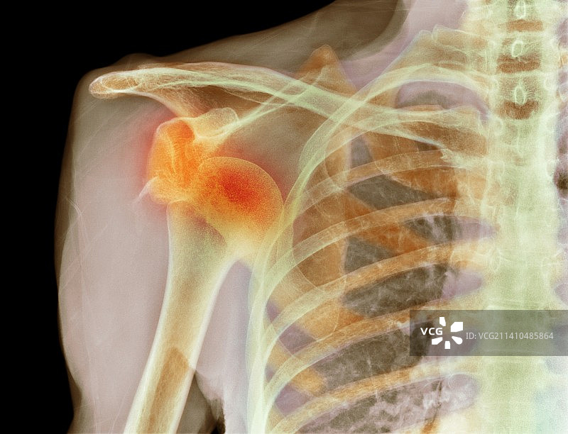 肩关节脱位X光片图片素材