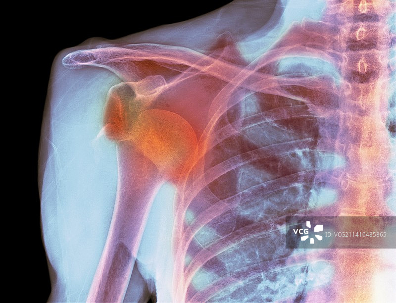 肩关节脱位X光片图片素材