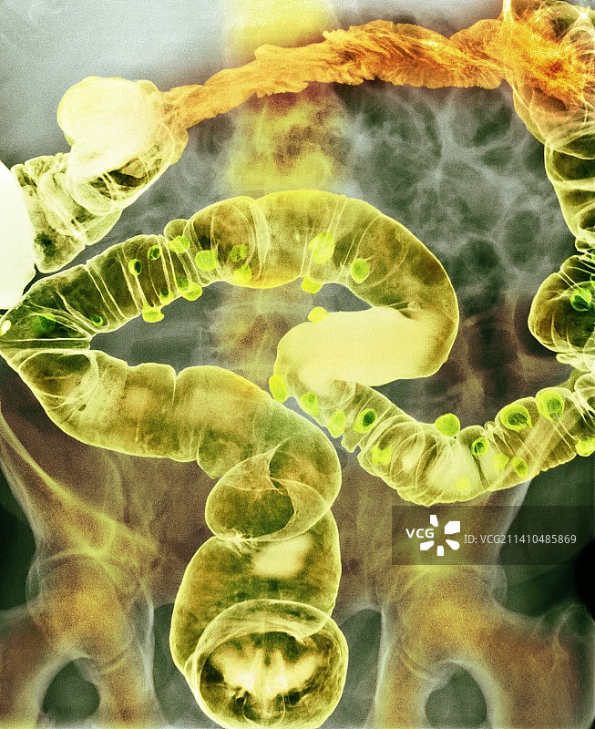 憩室炎X光片图片素材