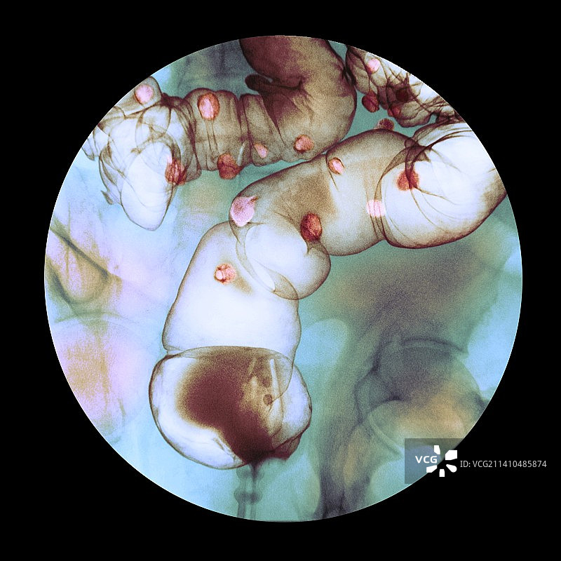 憩室炎X光片图片素材