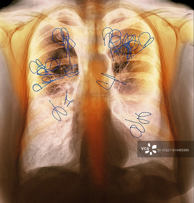 支气管内活瓣，X光片图片素材