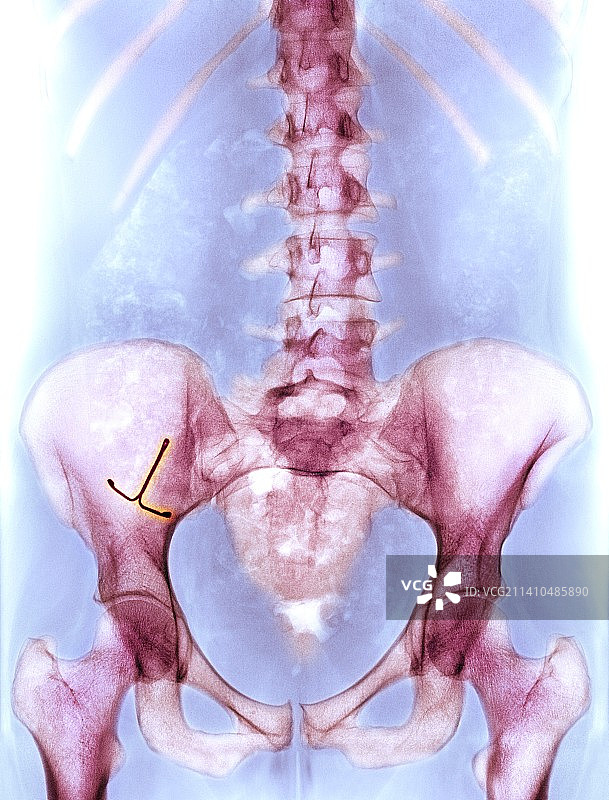 异位IUD避孕具X光片图片素材