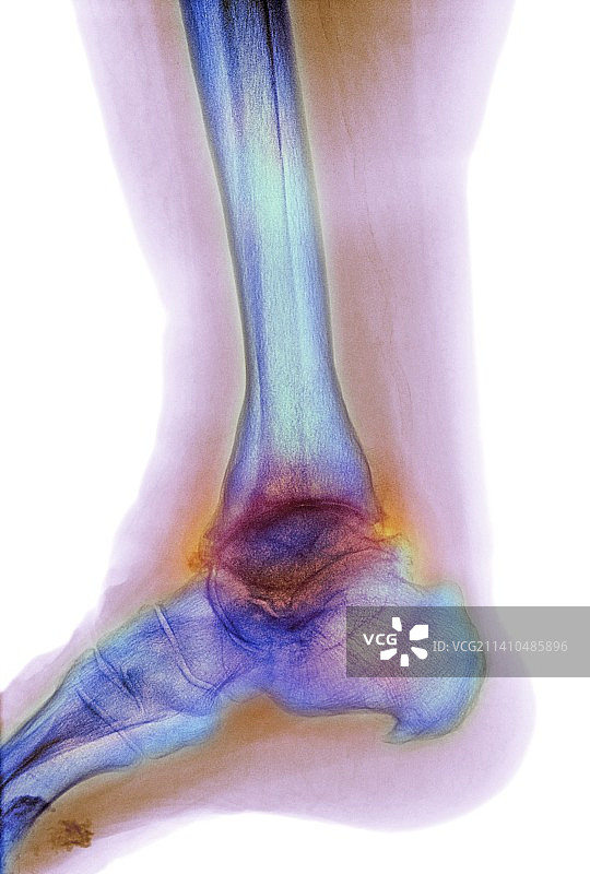 踝关节骨关节炎X光片图片素材