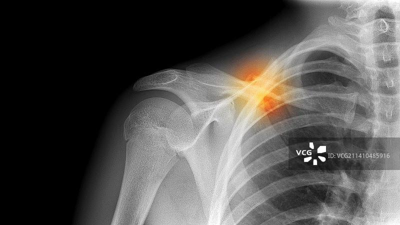 锁骨骨折，X光片图片素材